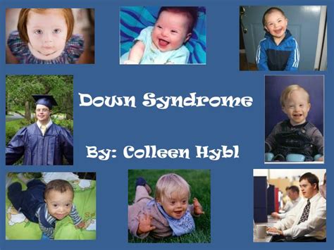 Ppt Down Syndrome Powerpoint Presentation Free Download Id3514969