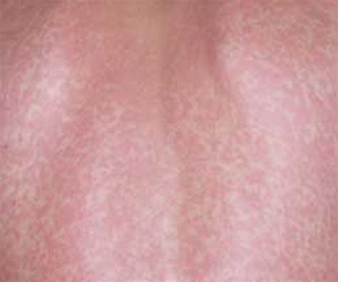 Stress Rash Pictures Symptoms Treatment Causes Inside The Clinic