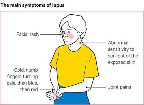 Lupus Sle Causes Symptoms Treatment Versus Arthritis