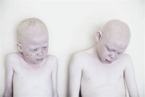 Under The Same Sun Poruszające Zdjęcia Dzieci Albinosów Jeszcze