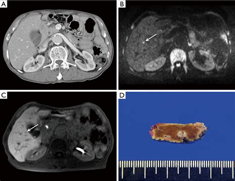Imaging Study For Colorectal Liver Metastasis Beyond The Diagnosis And