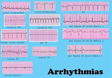 Dysrhythmia Cheat Sheet Cardiac Dysrrhythmia Aka Arrhythmia And
