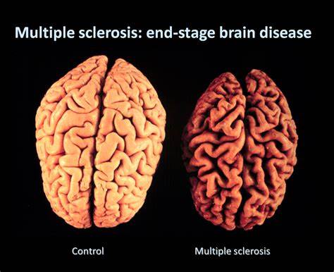 Рассеянный склероз диета гипертония | МОСМЕДПРЕПАРАТЫ гипертония | МОСМЕДПРЕПАРАТЫ Рассеянный склероз диета