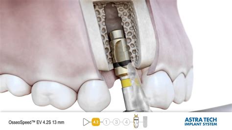 Astra Tech Implant System Ev Osseospeed Ev Implantation Youtube