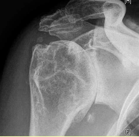 Shoulder Arthritis / Rotator Cuff Tears: causes of shoulder pain: Shoulder arthroplasty ...