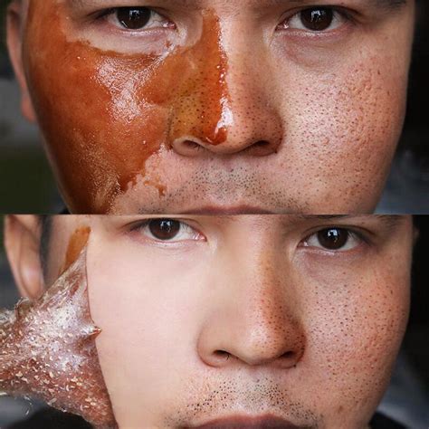 Jun 05, 2020 · how to prevent sunburn peeling. Honey tearing mask Peel Mask oil control painless ...