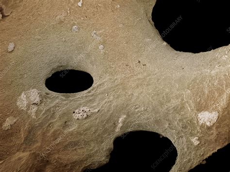 Osteoporotic Bone Sem Stock Image M2300331 Science Photo Library