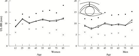 topographic anatomy of the eyelids and the effects of sex and age british journal of