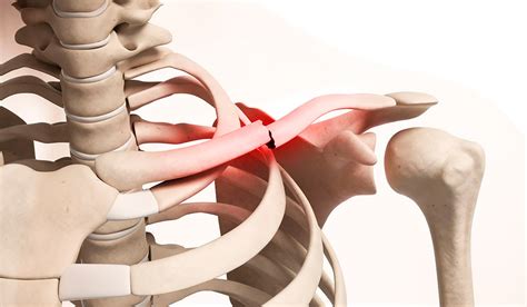 Fratura Da Clavícula Dr Eduardo Neri
