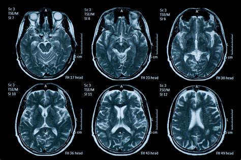 Un Estudio Revela Un Amplio Espectro De Complicaciones Cerebrales De