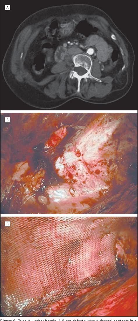 Figure 1 From Controversies In The Current Management Of Lumbar Hernias