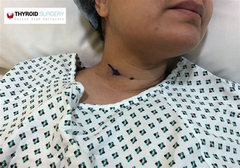 Minimal Invasive Parathyroid Surgery In Alzahra Thyroid Center With Dr