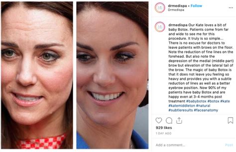 Kate Middleton Botox Rumours Shut Down