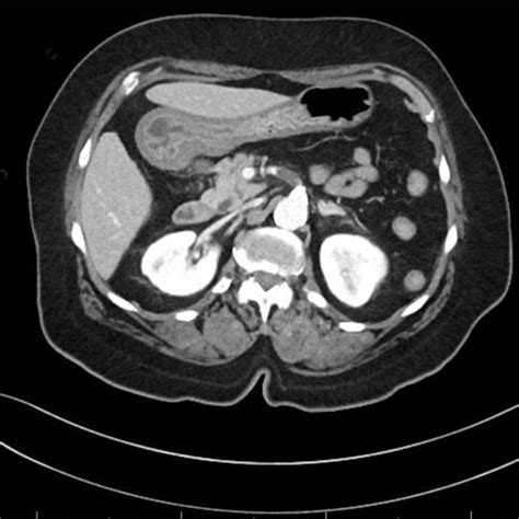 Ct Abdomen And Pelvis With Iv Contrast Axial Image Of 17 Cm Occlusive