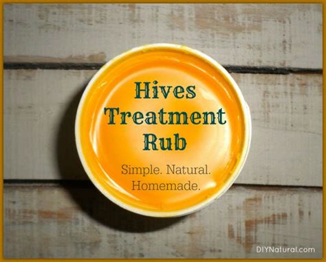 Hives Treatment A Natural Homemade Healing Rub Recipe