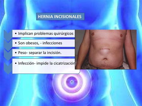 Hernia Abdominal Sintomas