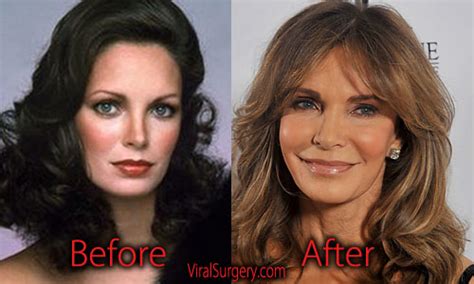 Jaclyn Smith Plastic Surgery Before And After Facelift Botox Pictures
