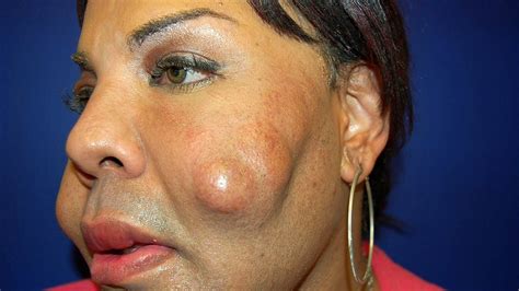 Cosmetic Surgery Disaster Woman Dubbed Cement Face Given New Lease Of Life Youtube