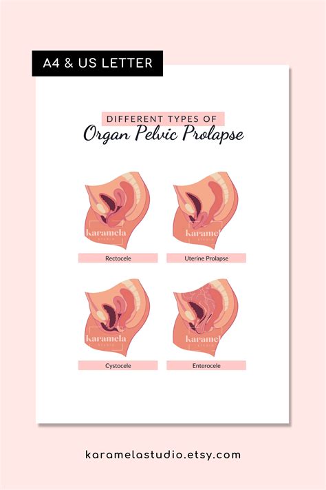 Printable Diagrams Of Pelvic Organ Prolapse Pelvic Floor Etsy UK In