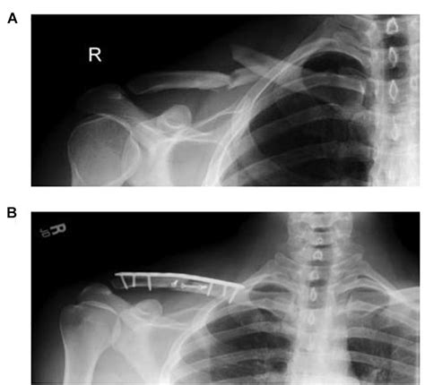 Frontiers Effects Of Internal Fixation For Mid Shaft Clavicle