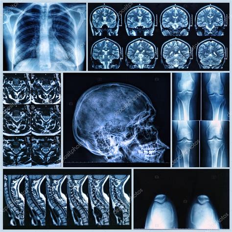Radiograf A De Huesos Humanos
