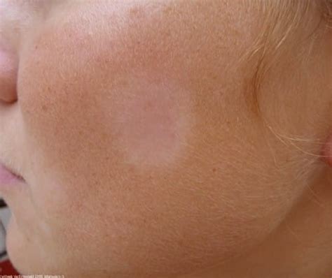 The cause of pityriasis alba is unknown, although it has been regarded as a manifestation of another skin disorder. Pityriasis Alba - Pictures, Causes, Symptoms, Treatment ...