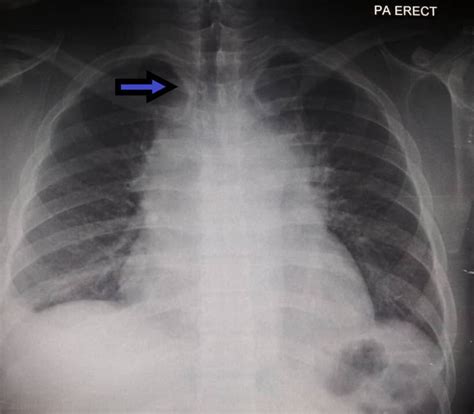 Mediastinal Lymphoma Presenting With Asymmetrical Chest Wall Bmj Case