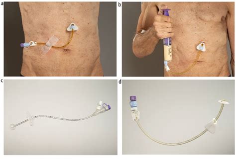 Clinical Photographs Of A Peg Tube A Depicts A Patients Abdominal