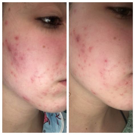 Does This Look Like Improvement Pics General Acne Discussion