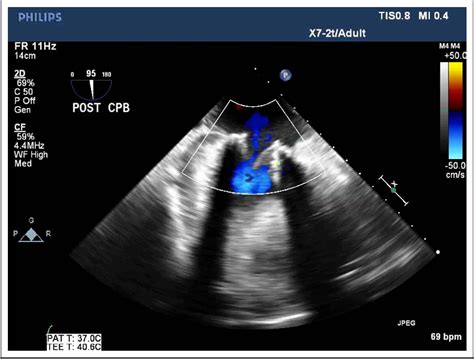 Figure 1 From First In Human Experience With Transcatheter Mitral Valve