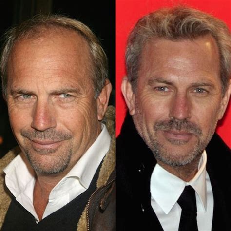 Celebrity Hair Transplants Kevin Costner Hair Transplants