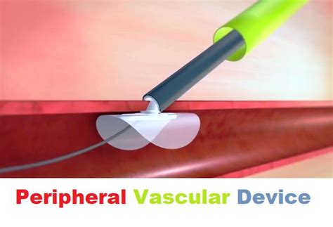 Peripheral Vascular Devices Market Size Worth 89188 Million By 2020