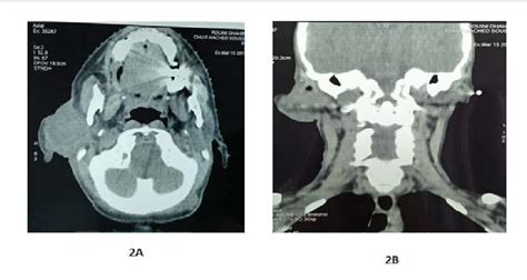 Figure 2 From Parotid Gland Metastasis From Breast Origin Semantic