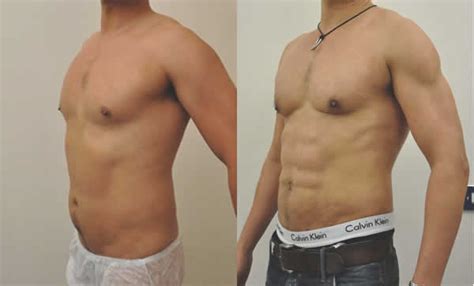 Six Pack Abs Abdominal Etching Six Pack Surgery