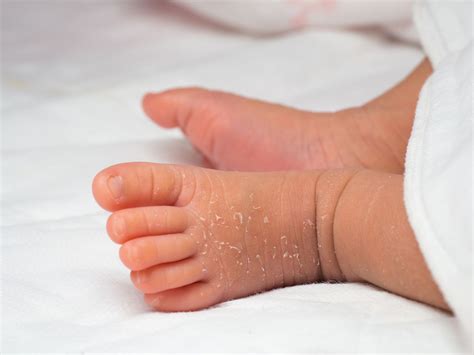 Newborn Skin Peeling Causes And Treatment