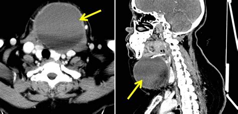 Thyroglossal Duct Cyst Radiology Cases