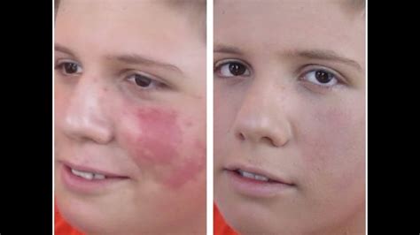 6 are moles considered what is an angel's kiss birthmark? TUTORIAL: How To Cover A Birthmark/Tattoo with Makeup - YouTube