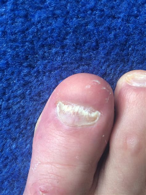 Starting at the base of your nail, use a downward stroke to apply an even coat of nail polish to the middle of your nail. My Personal Journey in Curing Nail Fungus for Good - A ...