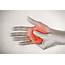 Hand Pain Tingling Numbness  West Suburban Relief