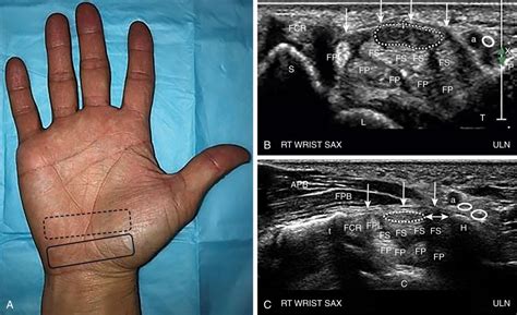 Ultrasound Guided Release Of The Transverse Carpal Ligament Carpal