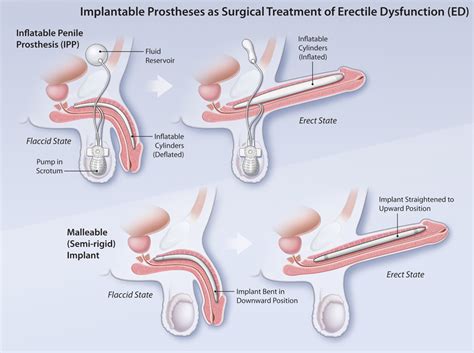 Erectile Dysfunction Treatment With Cialis
