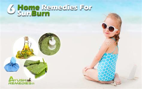 6 Best Home Remedies For Sunburn Get Rid Of Sunburn Naturally