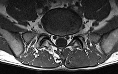 A Cross Sectional Mri Of The Lumbar Spine Showing Facet Joint