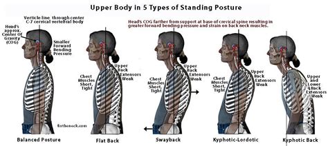 Chiropractic And Posture 34th Street Chiropractic And Wellness