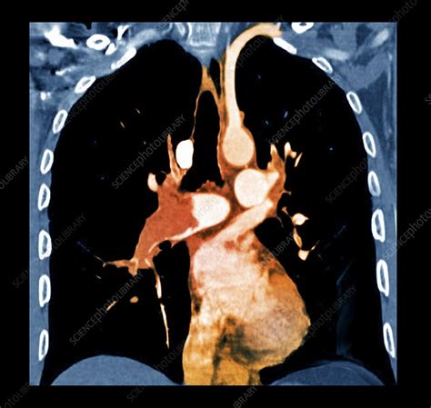 Pulmonary Embolism Ct Scan Stock Image C0269988 Science Photo