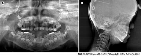 Crouzon Syndrome In A Fraternal Twin A Case Report And Review Of The
