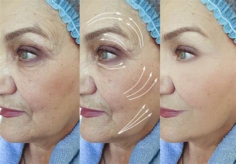 Face Woman Wrinkles Lifting Difference Tightening Plastic Therapy