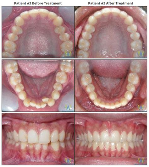 Invisalign Before And After Severe Crowding