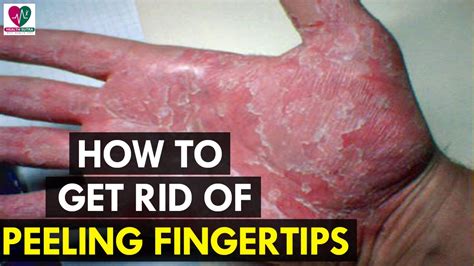 How To Get Rid Of Peeling Fingertips Health Sutra Youtube