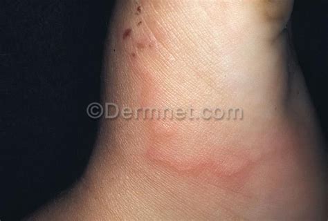 Skin Parasites Lovetoknow Skin Parasites Skin Parasite